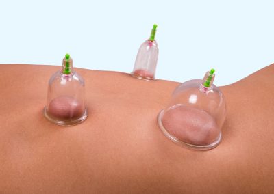 Cupping