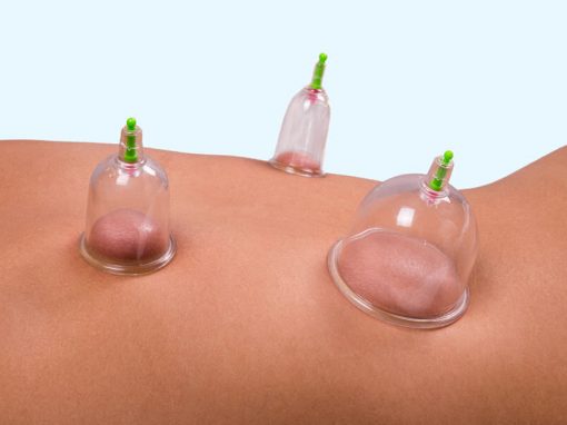 Cupping